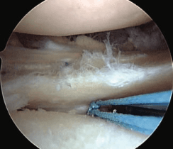 Arthroscopic view of a torn meniscus inside the knee