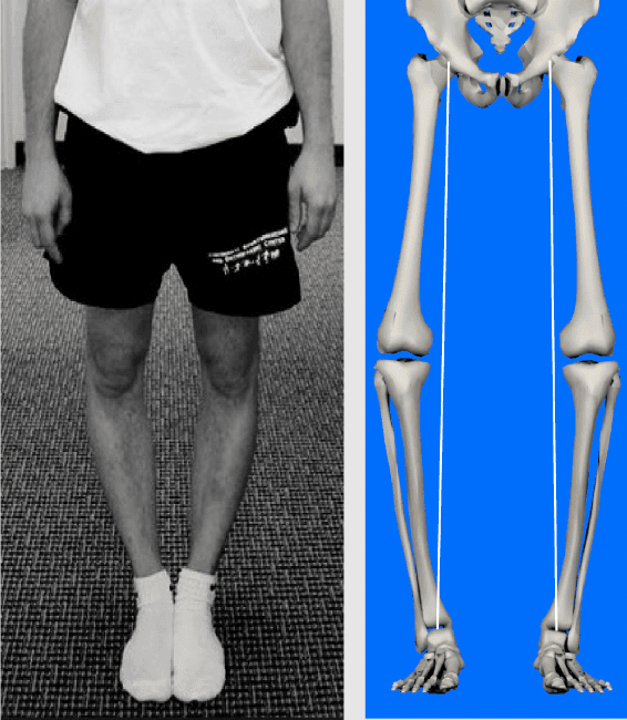Functional alignment planning for total knee replacement