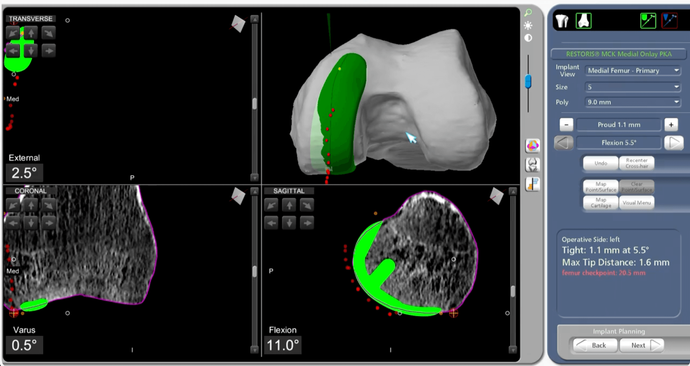 Mako CT-based 3D surgical plan of a knee, showing implant size, position and angle mapped onto a model of the joint